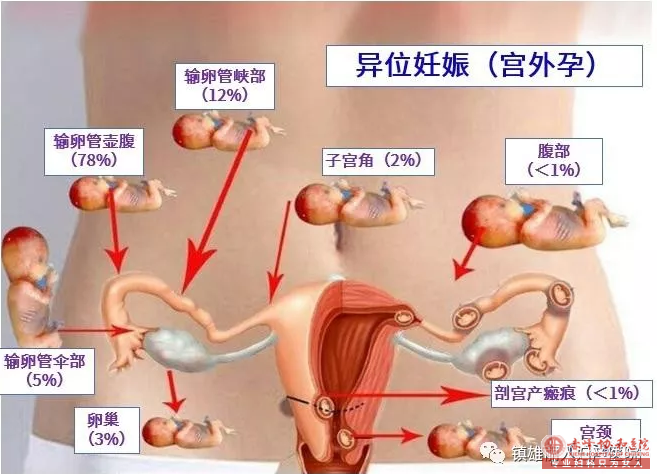 赤峰“要命”的宫外孕是怎么引起的?有什么症状?