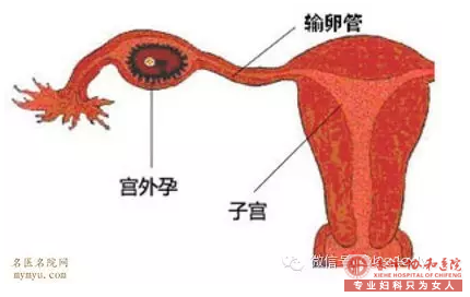 金华宁城县宫外孕的预防怎么做？